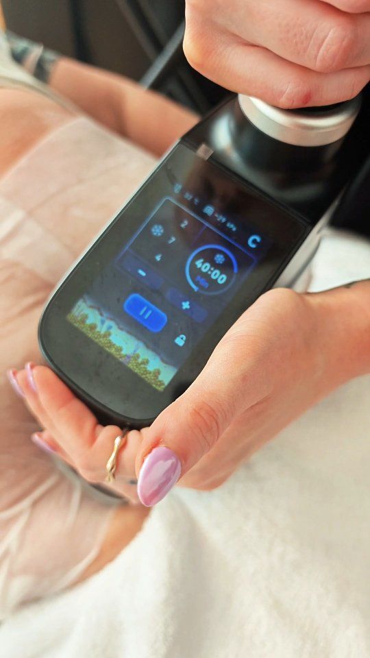 Die Kryolipolyse ist eine nicht-invasive Methode zur Fettreduktion, bei der Fettzellen durch gezielte Kälteeinwirkung zerstört werden. Besonders beliebt ist die Behandlung am Bauch, da sich hier oft hartnäckige Fettdepots befinden. Während der Behandlung wird ein spezieller Applikator auf die gewünschte Stelle gesetzt, der das Gewebe ansaugt und kontrolliert kühlt. ❄️ Die Sitzung dauert in der Regel zwischen 30 und 60 Minuten und ist weitgehend schmerzfrei. Nach der Behandlung kann es zu leichten Rötungen, Schwellungen oder einem Taubheitsgefühl kommen, die jedoch nach kurzer Zeit wieder abklingen. Wichtig ist, dass man in den Wochen nach der Behandlung auf eine gesunde Ernährung und ausreichend Bewegung achtet, um die besten Ergebnisse zu erzielen. Erste Veränderungen sind oft nach etwa 4 Wochen sichtbar, das endgültige Ergebnis zeigt sich jedoch meist nach 8 bis 12 Wochen. Die zerstörten Fettzellen werden über das Lymphsystem auf natürliche Weise abgebaut. Eine Kryolipolyse ersetzt keine gesunde Lebensweise, kann aber gezielt bei Problemzonen unterstützen. Vor der Behandlung sollte immer ein ausführliches Beratungsgespräch mit unseren Profis erfolgen, um individuelle Fragen und Erwartungen zu klären.

Ab sofort ist diese Behandlung bei uns buchbar.

Wir empfehlen eine Kombination Behandlung aus Kryolipolyse, Radiofrequenz und Ultraschall Kavitation.